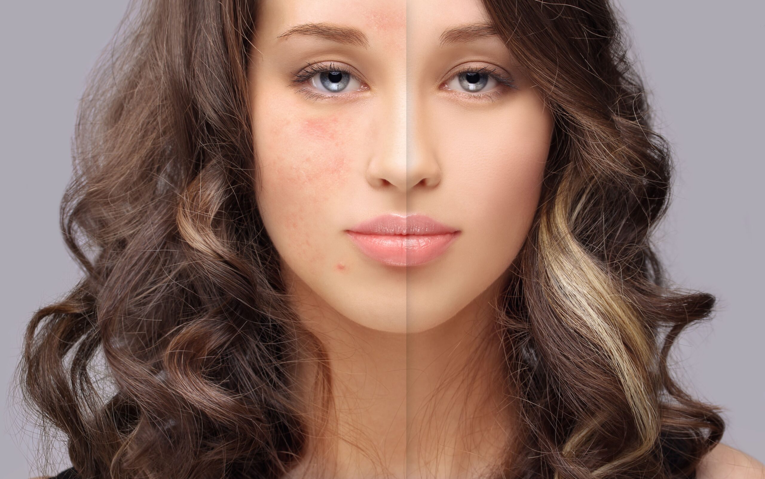 Skin discoloration